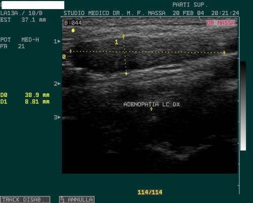 ADENOPATIA LC DX