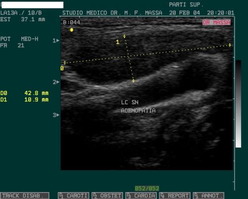 ADENOPATIA LC SN