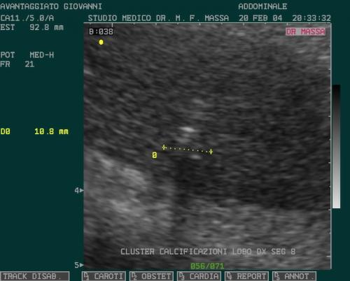 CALCIFIC EPATICHE