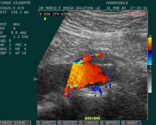 DISSEZIONE AORTA