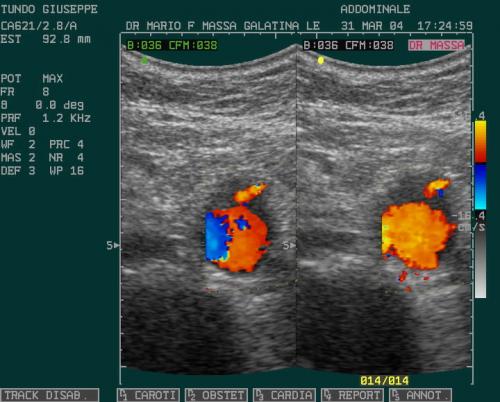 DISSEZIONE AORTA1