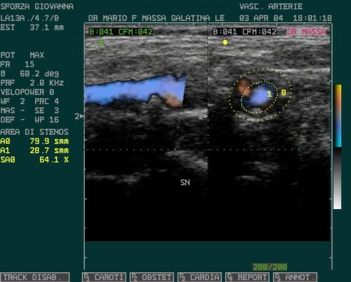 STENOSI CAROTIDE 1